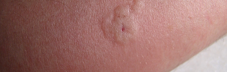 Bee Sting on Skin